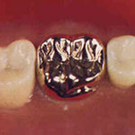 Invisalign Compare